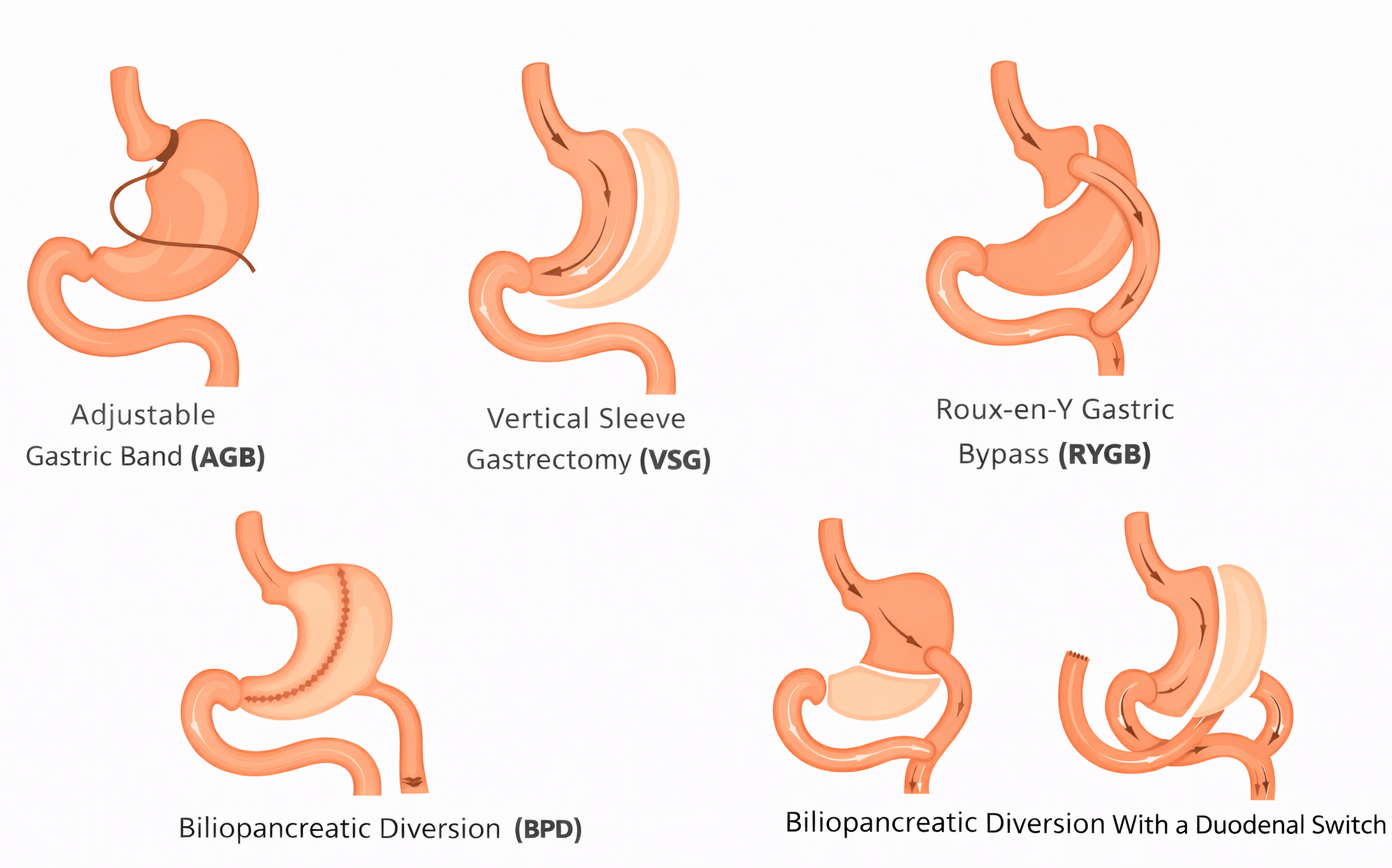 Bariatric Surgery in Panipat