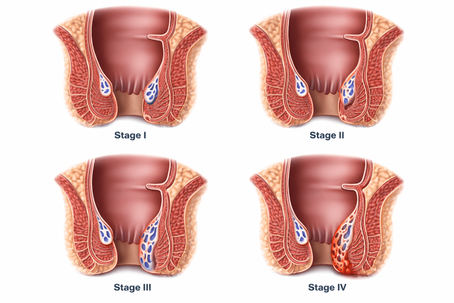 Piles Treatment in Panipat