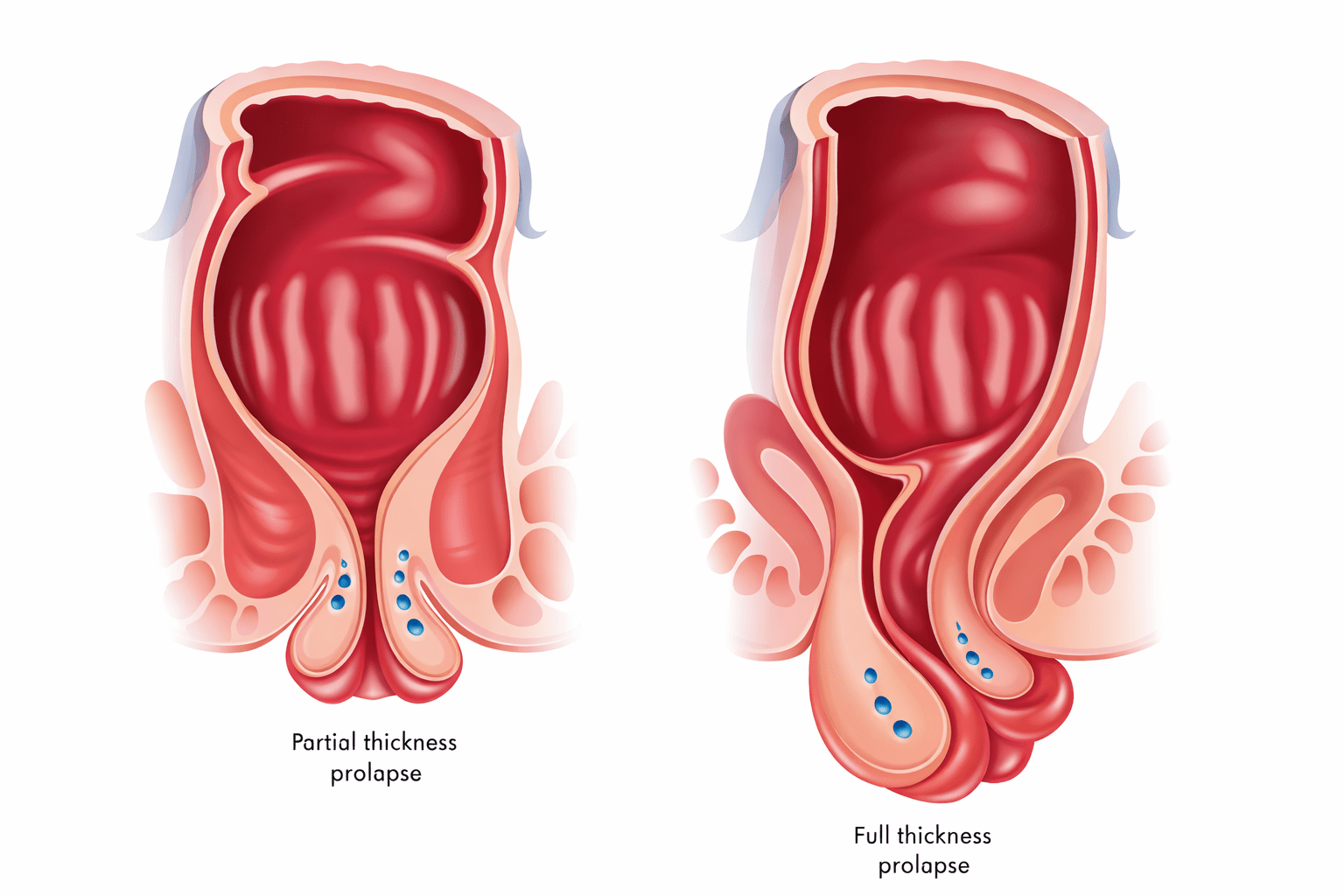 Rectal Prolapse Surgery in Panipat