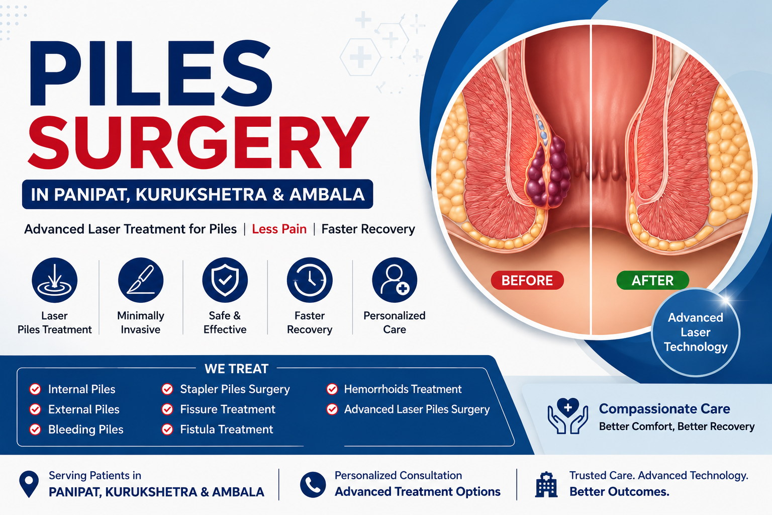 Best Piles Surgery in Panipat, Kurukshetra & Ambala